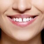 snap-on-smile-6.jpg